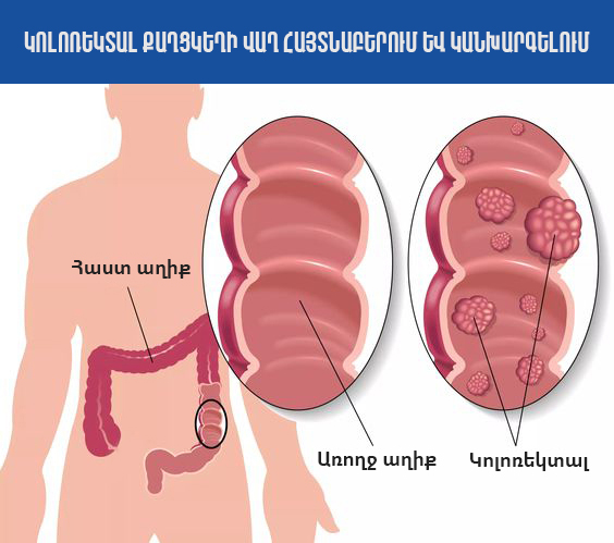 50-75 տարեկան քաղաքացիների շրջանում կոլոռեկտալ քաղցկեղի վաղ հայտնաբերման սքրինինգային ծրագիրը 2023-ին կշարունակվի